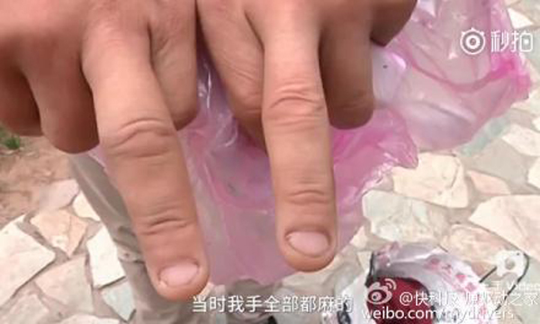 男子手部和臉部不同程度被炸傷。